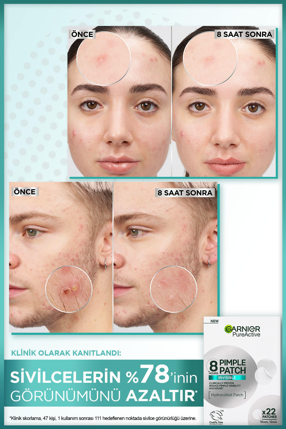 Garnier Pimple Patch 22'li Sivilce Bandı / Hidrokolloid Bant / Akne Karşıtı 22li Bant-