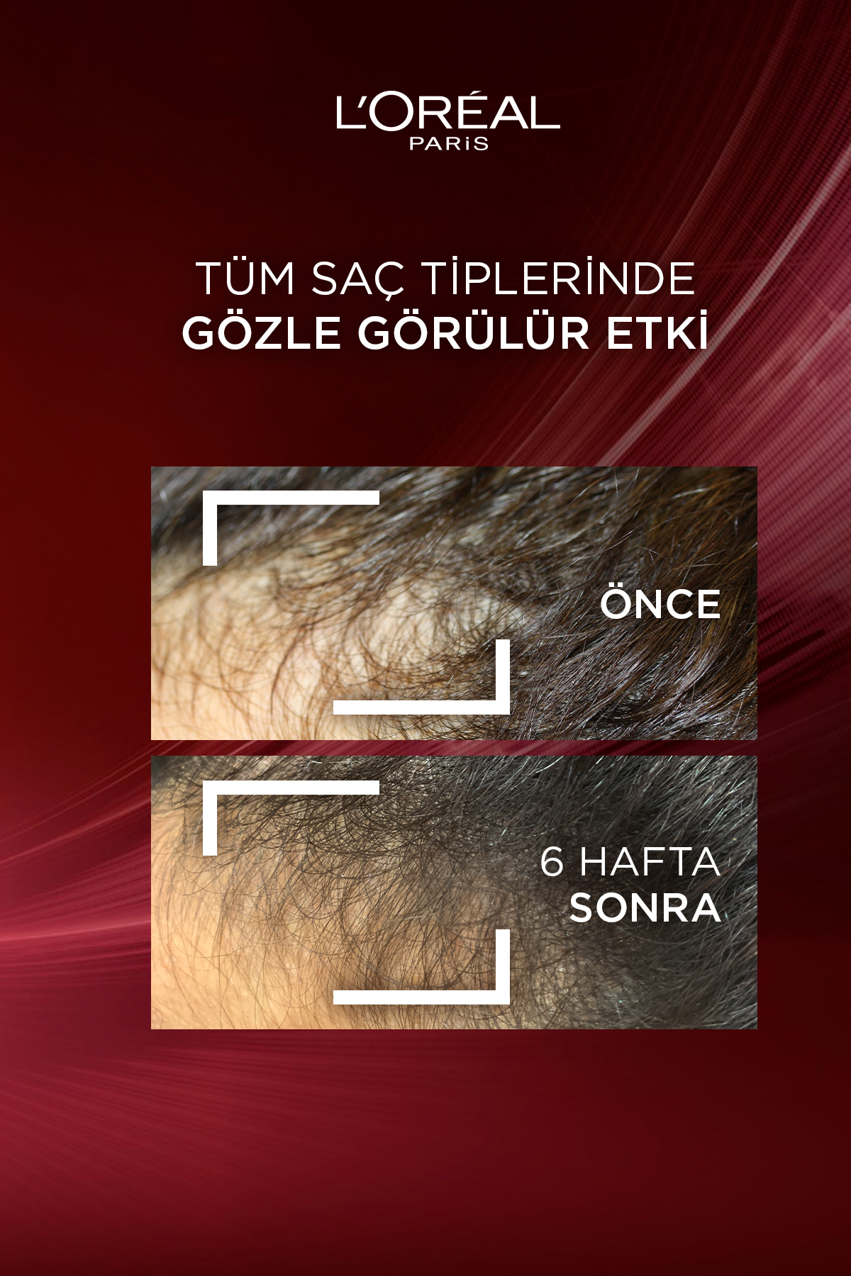 Elseve Şampuan Dökülme 300ml-